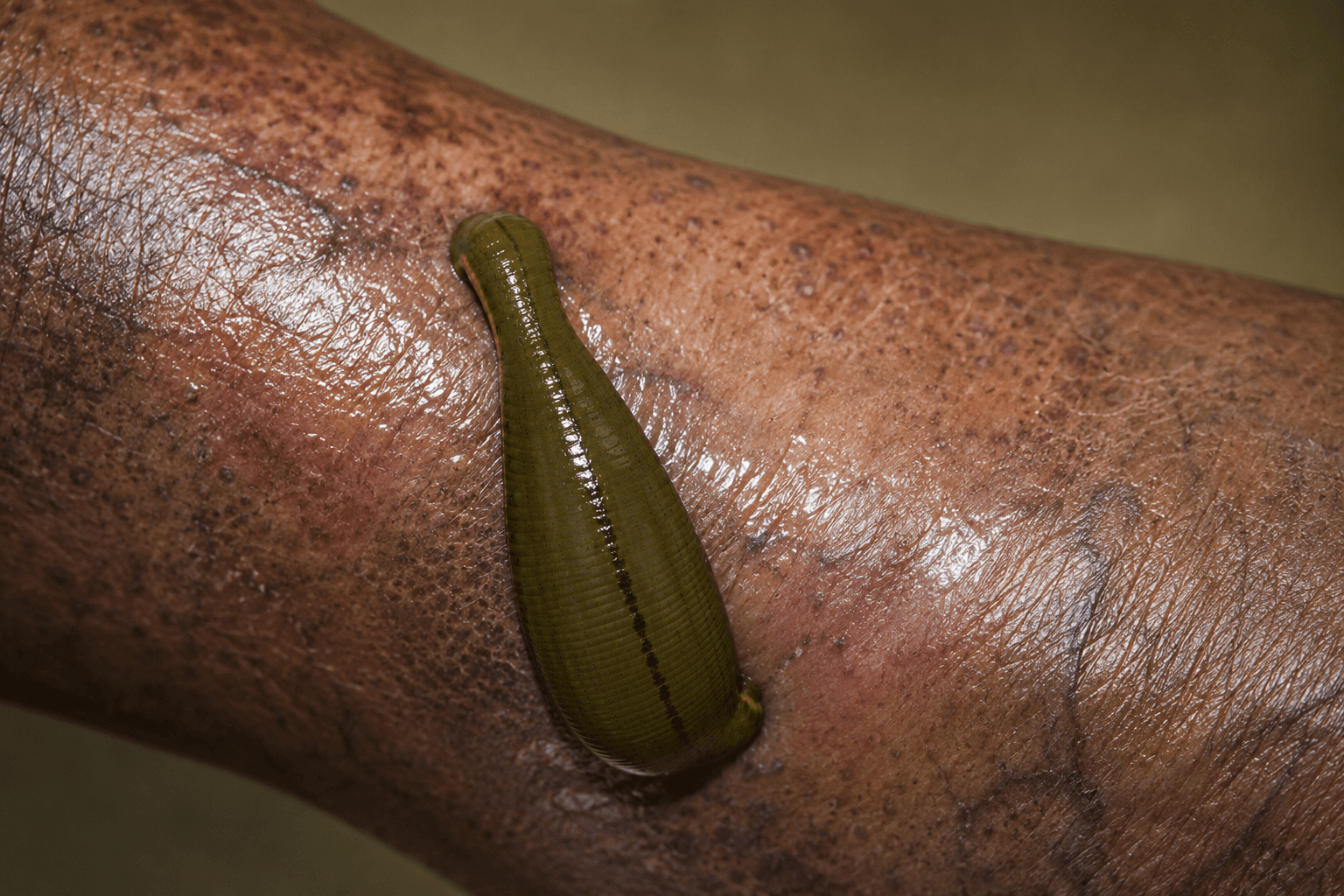 Jalaukavacharana treatment visual 2